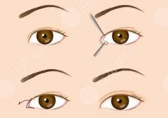 埋線雙眼皮可以維持多久？埋線后材料脫落怎么辦呢？