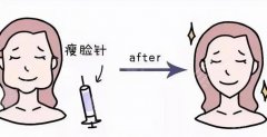 注射瘦臉間隔多久打一次？什么樣的人適合做注射瘦臉呢？