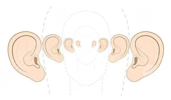 耳朵整形