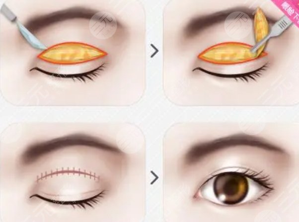 雙眼皮修復(fù)