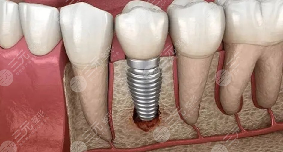 種植牙