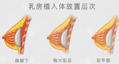 隆胸做假體還是自體脂肪好？哪些因素會(huì)影響材料的使用壽命呢？