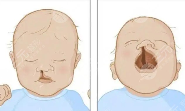 唇腭裂鼻孔一大一小