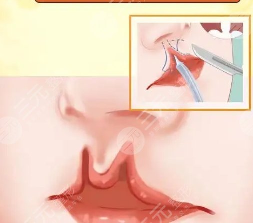 唇腭裂鼻孔一大一小