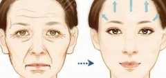 額顳部小切口除皺術如何？術后效果可以維持多久呢？