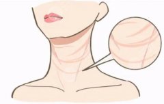 頸部除皺提升術效果如何？常見的除皺手術方式有哪些？