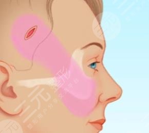 內(nèi)窺鏡除皺