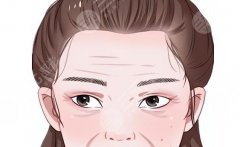 內(nèi)窺鏡除皺的副作用有哪些？與傳統(tǒng)除皺有哪些區(qū)別？