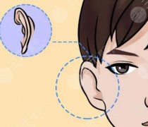 招風(fēng)耳整形手術(shù)怎么做的？做手術(shù)需要住院嗎？術(shù)后如何護(hù)理