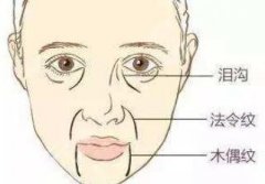 面部懸吊術是什么做的？手術切口一般在哪里？護理tips分享