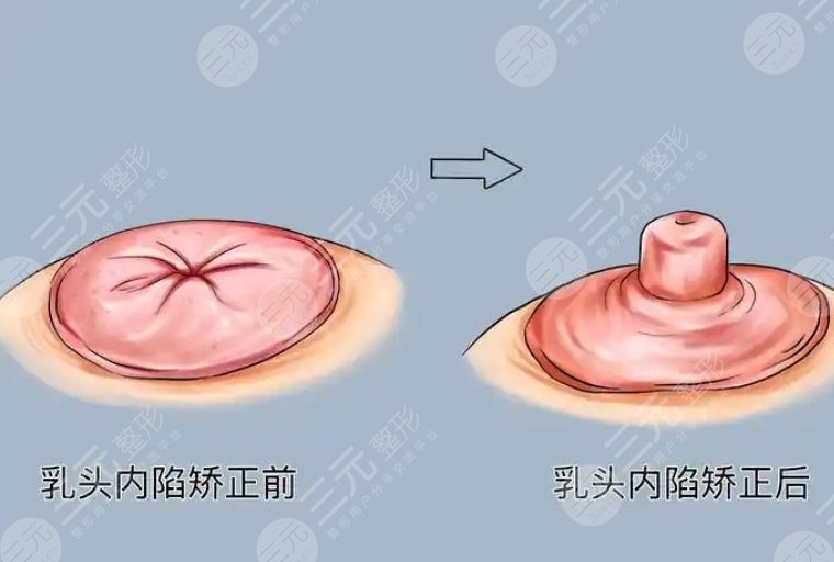 乳頭內陷