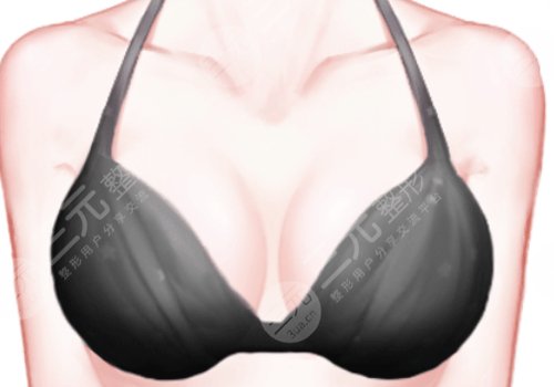 西安醫(yī)學(xué)院二附院隆胸費(fèi)用