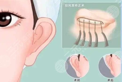 耳部整形
