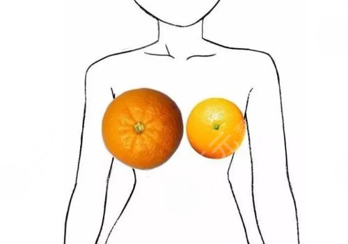 南醫(yī)大深圳醫(yī)院縮胸多少錢(qián)