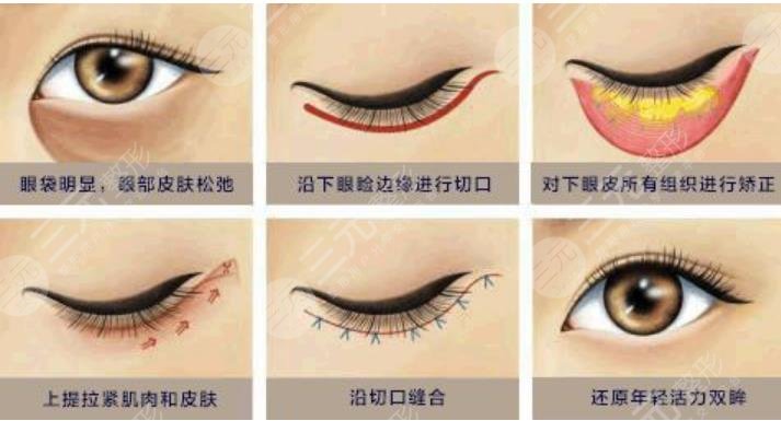 祛眼袋