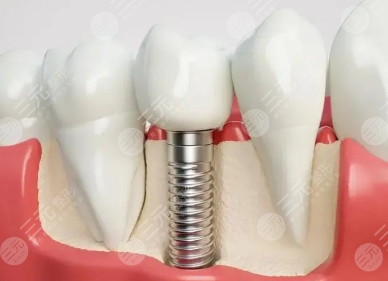 牙齒種植