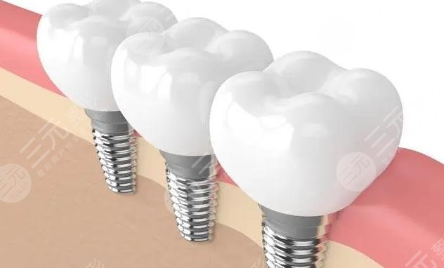 牙齒種植