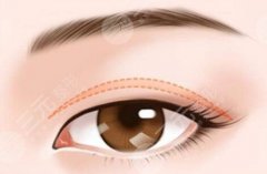 浙大一院雙眼皮多少錢？含費用詳情與實力醫(yī)生這里查看