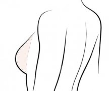 八大處于浩醫(yī)生隆胸技術(shù)分析|附真實的胸部整形案例！