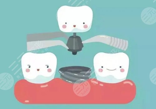 南充市中心醫(yī)院種牙收費(fèi)標(biāo)準(zhǔn)