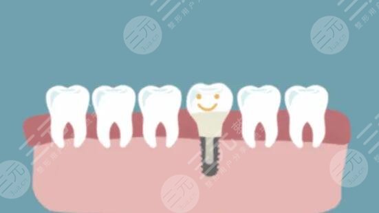 牙齒種植
