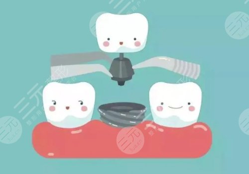 上海九院種牙的價(jià)格一般都是多少錢(qián)