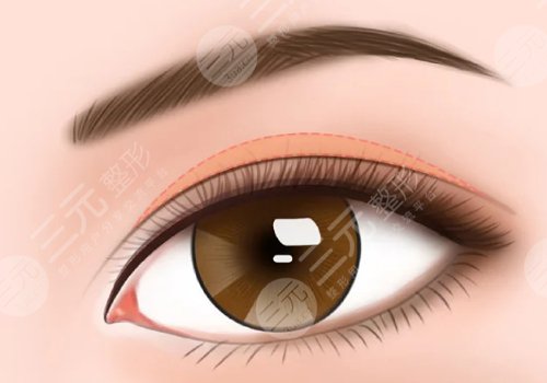 上海藝星哪個(gè)醫(yī)生做雙眼皮比較好