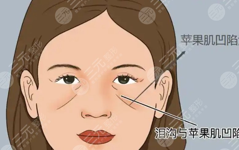 蘋果肌填充動漫