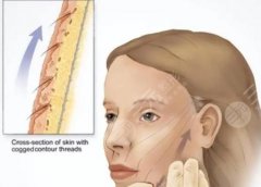 面部筋膜提升后遺癥是什么？術(shù)前避坑指南來了！