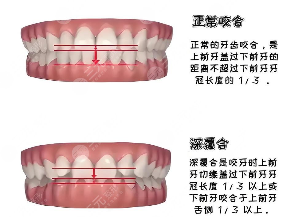 深覆合矯正到底是什么?