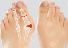 大腳骨手術(shù)：后遺癥知多少？輕松應(yīng)對(duì)康復(fù)路！