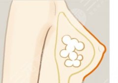 豐胸二選一：自體脂肪豐胸和假體豐胸哪個(gè)好？