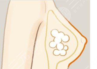 脂肪豐胸和假體豐胸