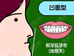 20歲地包天矯正需要多少錢(qián)？效果好不好？原理介紹