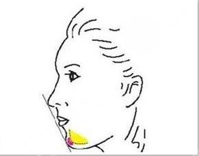 頦成型和假體隆下巴，到底哪種好?