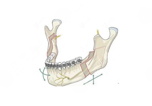 新華醫(yī)院正頜手術(shù)價格