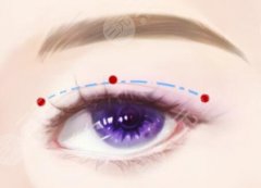 廣東雙眼皮醫(yī)生推薦|魯峰、馮傳波等醫(yī)生真實(shí)測(cè)評(píng)