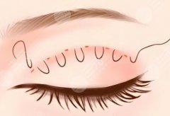 廣州割雙眼皮哪家強？三甲+連鎖私立TOP5清單！各種選擇都有