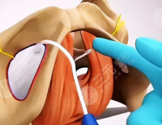 3D束帶緊縮手術(shù)治療漏尿有用嗎？真實情況這里給你說透