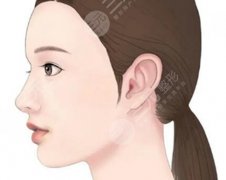 矯正骨性嘴凸多久恢復(fù)？?jī)?nèi)行人扒清恢復(fù)時(shí)間_避坑點(diǎn)