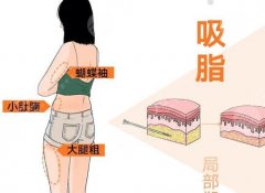 超聲波抽脂恢復(fù)期多久？影響恢復(fù)的關(guān)鍵因素公布啦