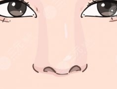 鼻小柱延長(zhǎng)怎么做？一篇說清鼻小柱延長(zhǎng)咋做|看完再也不被忽悠