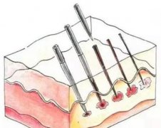 微針嫩膚的效果能維持多久？這幾點(diǎn)決定你皮膚好狀態(tài)能撐多久