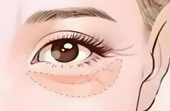 外路去眼袋恢復(fù)期有多久？恢復(fù)期避雷指南|別等留疤才看