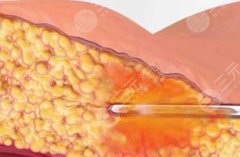 做水動(dòng)力吸脂會(huì)不會(huì)很痛？過(guò)來(lái)人實(shí)測(cè)醫(yī)生拆解|怕痛黨必看