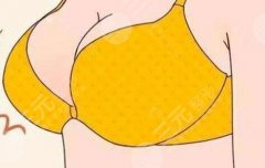 德國(guó)寶儷假體到底值不值得沖？?jī)?nèi)行人給你扒明白