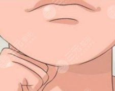 下巴后縮做正頜手術(shù)還是墊下巴？項(xiàng)目咋選|看完這篇不踩坑