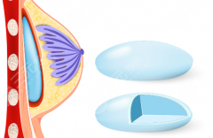 星熠假體多久會(huì)變軟？過來人實(shí)測(cè)這3個(gè)階段別慌|附護(hù)理小技巧