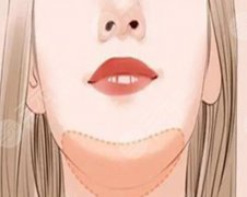 自體脂肪下巴多久恢復(fù)？過來人實(shí)測(cè)這3個(gè)階段護(hù)理就對(duì)了|速看