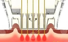 黃金微針和熱瑪吉的區(qū)別在哪？3分鐘搞懂倆“抗衰神器”的真實(shí)差別